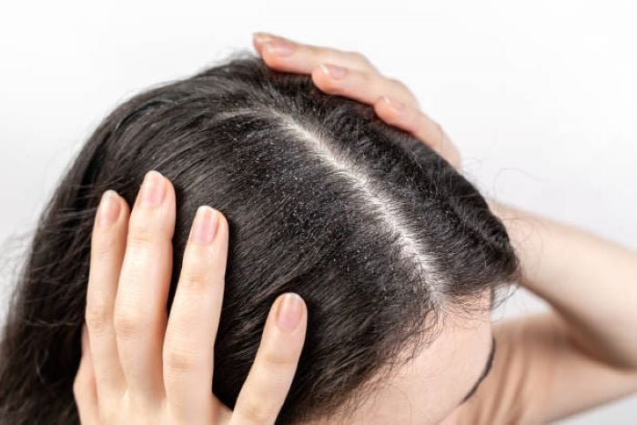 شامبو الكيتوكونازول (Ketoconazole): يقضي على الفطريات المُسببة لقشرة الشعر. شامبو كبريتيد السيلينيوم (Selenium sulfide): يملك خصائص مضادة للفطريات أيضًا. طريقة إزالة القشرة من الشعر نهائياً